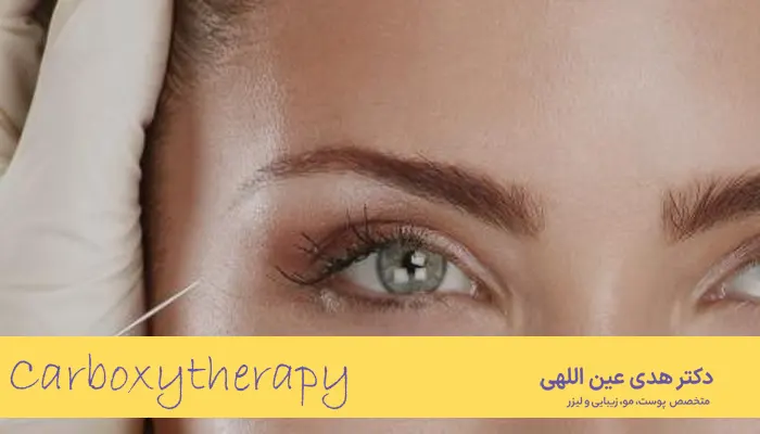 Carboxytherapy