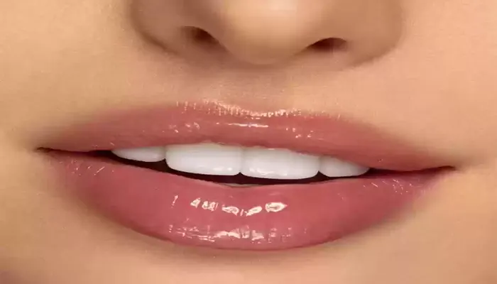 تزریق ژل لب مدل نچرال