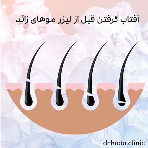 آفتاب گرفتن قبل از لیزر موهای زائد