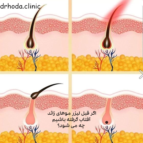 عوارض آفتاب گرفتن قبل لیزر