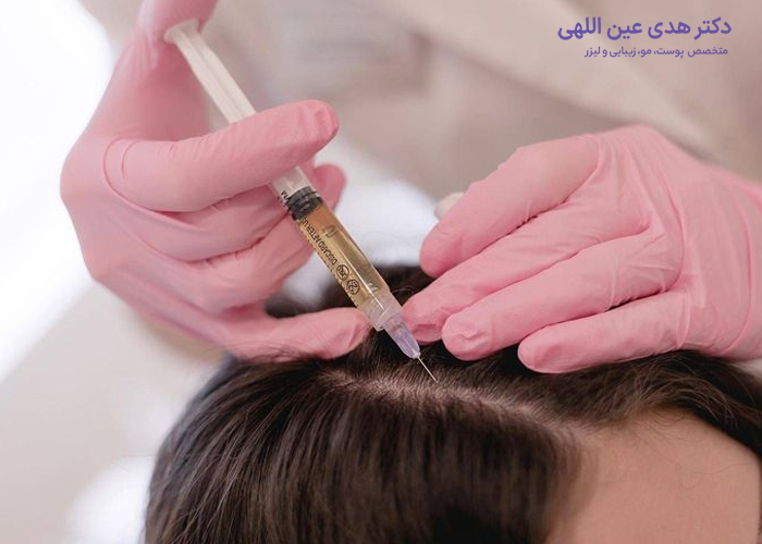 مزوتراپی و ریزش مو