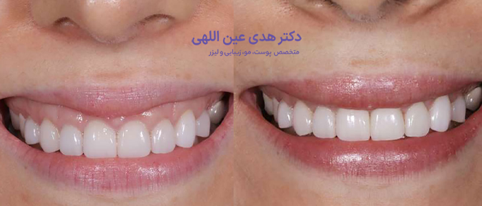 اصلاح لبخند لثه‌ای با بوتاکس