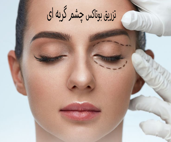 تزریق بوتاکس چشم گربه ای
