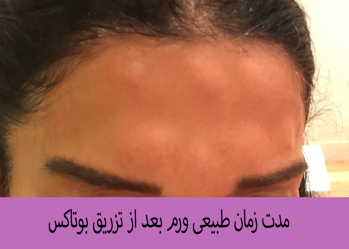 مدت زمان طبیعی ورم بعد از تزریق بوتاکس