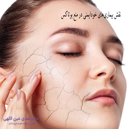 نقش بیماری‌های خودایمنی در منع بوتاکس