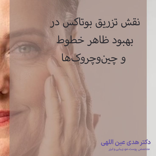 بوتاکس