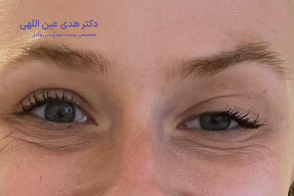 افتادگی پلک پس از بوتاکس