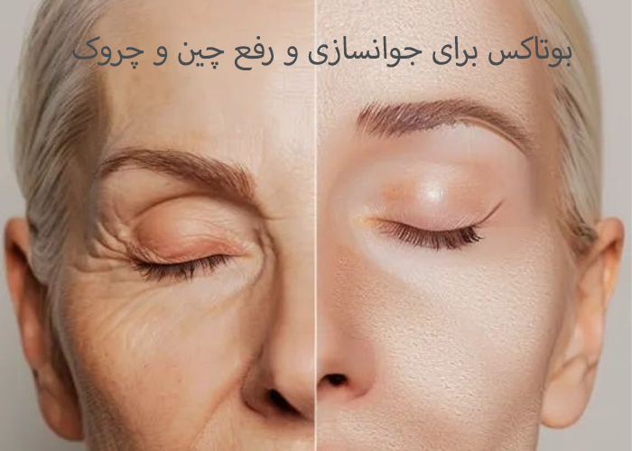 بوتاکس