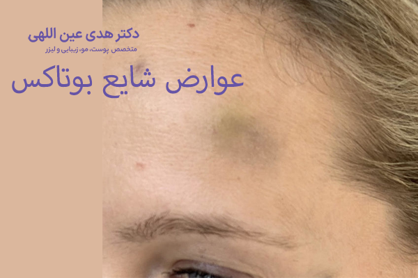 عوارض شایع بوتاکس