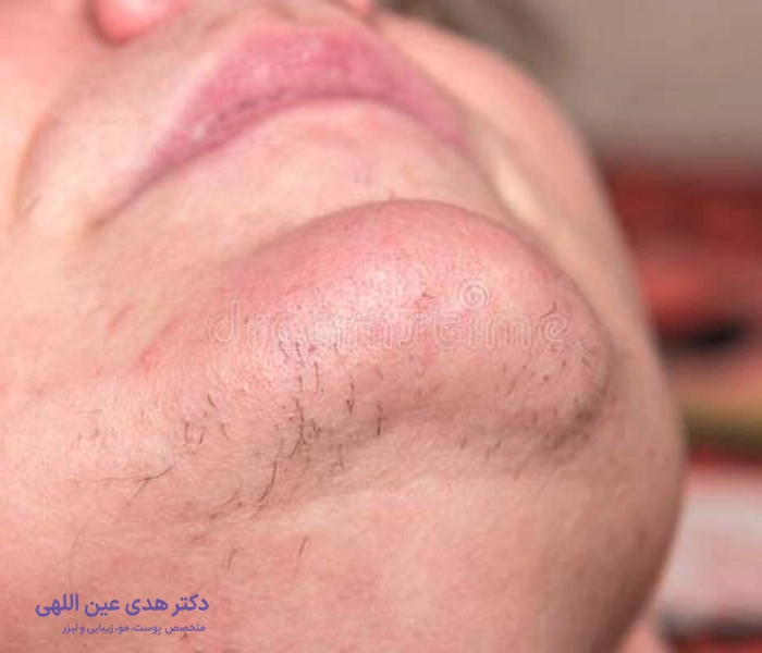 موهای زائد زیر چانه 