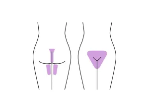 آیا لیزر بیکینی به پرده بکارت آسیب میزند؟