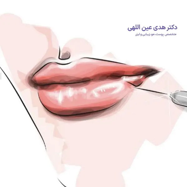 عوامل موثر در ماندگاری تزریق ژل