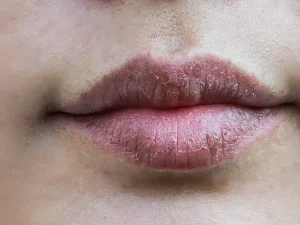 خشکی لب بعد از تزریق ژل