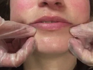 ماساژ لب پس از تزریق ژل