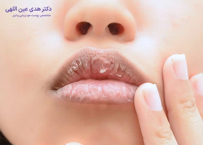 نحوه رفع خشکی لب ها پس از تزریق ژل
