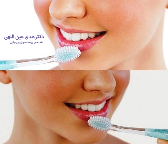 نکات مهم مسواک زدن بعد از تزریق ژل لب