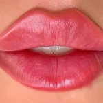 تزریق ژل لب روسی