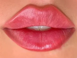 تزریق ژل لب روسی
