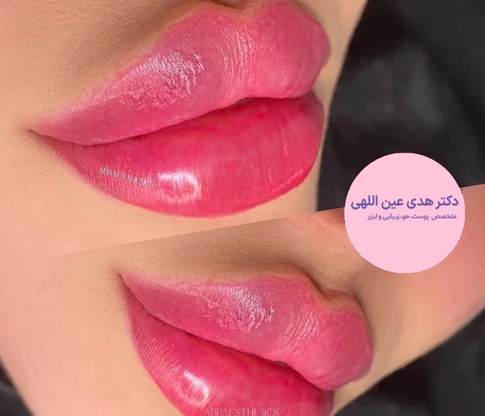 تزریق ژل لب روسی