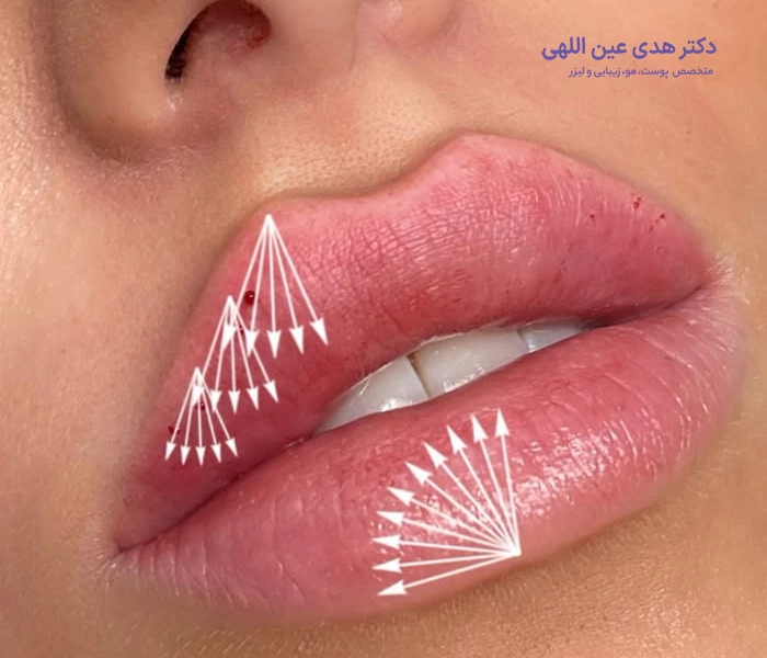 روش انجام تزریق ژل لب روسی