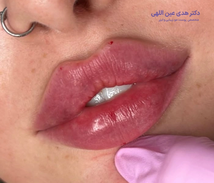 مراقبت‌های قبل از تزریق ژل لب روسی