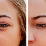 تزریق چربی به زیر چشم