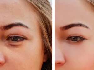تزریق چربی به زیر چشم
