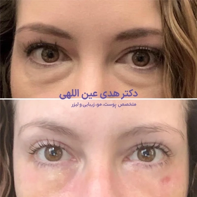 تزریق چربی به زیر چشم چیست؟