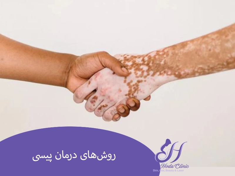 روش‌های درمان پیسی