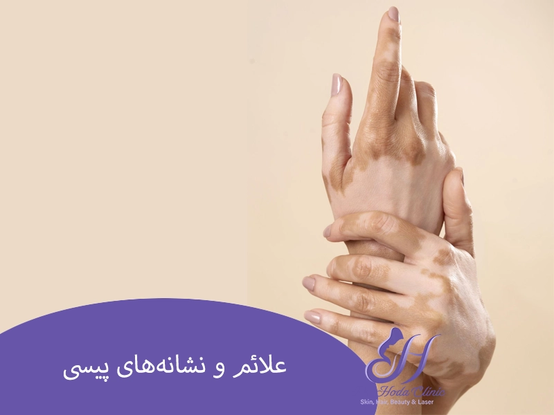 علائم و نشانه‌های پیسی