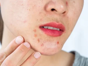 لکه های قرمز روی پوست